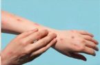 اولین مورد ابتلا به آبله میمونی تائید شد