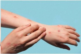 اولین مورد ابتلا به آبله میمونی تائید شد