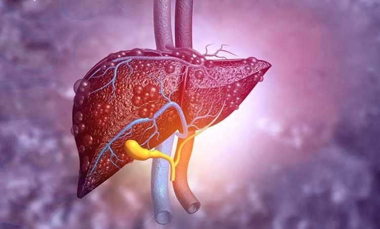 هشدار دفتر بهبود تغذیه جامعه وزارت بهداشت به درمان نادرست کبد چرب