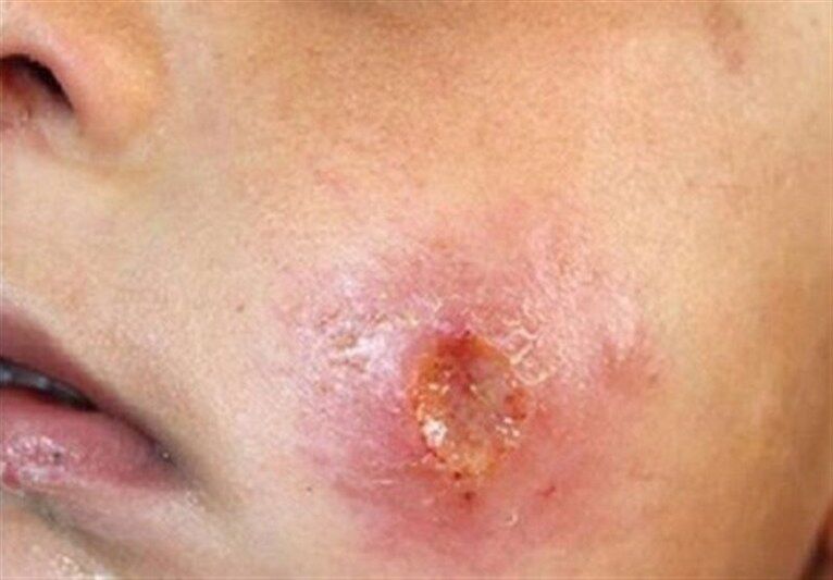 سالک بیماری پیچیده‌ای که نادیده گرفته شد